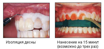 Процесс отбеливания Opalescence Boost