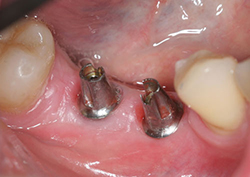 Два имплантата