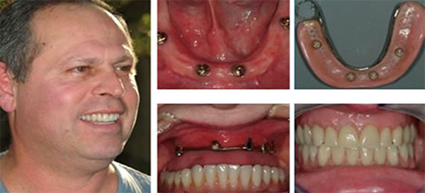 Результат имплантации зубов