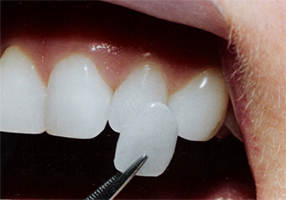 Керамические виниры