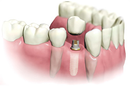Один имплантат